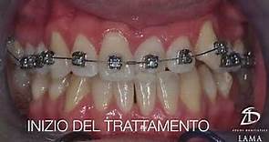 Trattamento ortodontico di Morso Inverso Anteriore con un apparecchio dentale fisso