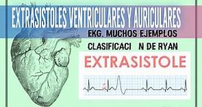 #cardiología | EXTRASISTOLES VENTRICULARES Y AURICULARES. CLASIFICACION DE RYAN. #medicina