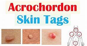 Skin Tags (Acrochordons) | Causes, Risk Factors, Symptoms, Diagnosis, Treatment