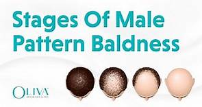 7 Stages of Male Pattern Baldness Explained by The Best Dermatologist | Oliva Clinic