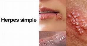 Herpes simple - ¿Qué es el herpes? - Herpes labial, herpes genital, herpes oral.