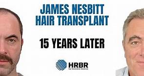 James Nesbitt Hair Transplant, Second Testimonial, 15 Years Later, HRBR - Hair Restoration Blackrock