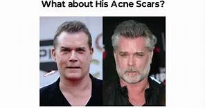 Ray Liotta Plastic Surgery Before And After