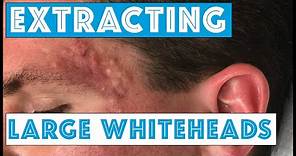 Acne Vulgaris and Extracting large Whiteheads - Part 1