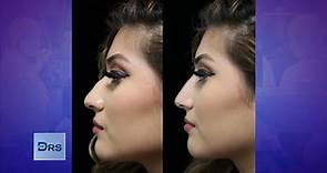 See Incredible Before and After Liquid Nose Job Results