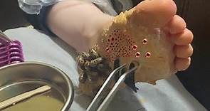 Removing TICKS and WORMS from the foot - trypophobia
