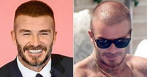 Top 20 Famous Celebrity Hair Transplants Before And After