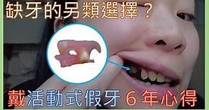 單顆缺牙 活動假牙 配戴6年心得 肉色可拆卸式局部活動假牙 彈性隱形義齒床 缺牙不一定要植牙或牙橋 活動假牙清潔