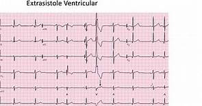 Extrasistole Auricular y Ventricular EKG
