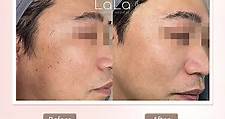 LaLa Beauty - 【CO2 Laser 脫疣療程🕳】實例展示，輕鬆脫 不留疤🫢👍 無痛無印，擊退疣😍🎉...