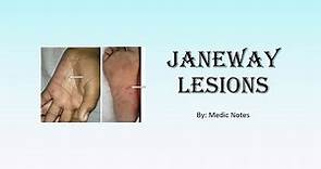 Janeway lesions - definition, causes, pathophysiology, sign value