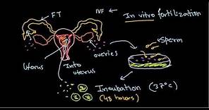 In vitro fertilization and embryo transfer (IVF procedure)