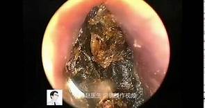 耳內鏡：操作處理外耳道膽脂瘤Endoscopic manipulation of external auditory canal cholesteatoma