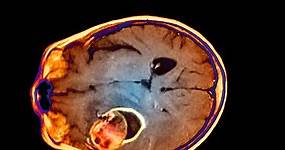 7 Ways To Spot A Brain Aneurysm Before It's Too Late