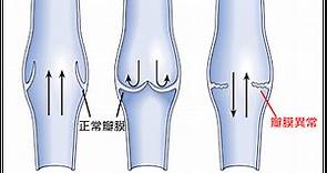 心臟瓣膜有逆流或閉鎖不全，會有什麼症狀呀