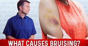 What Causes Bruising (Without Trauma) – Dr. Berg