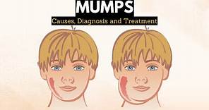 Mumps, Causes, Signs and Symptoms, Diagnosis and Treatment.