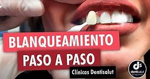 🦷😁 Blanqueamiento dental PASO A PASO 😁🦷 Antes y después - Clínica Dental Dentisalut