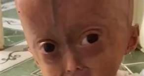 #eliseeloa #progeria #boavistarr #reel #fpy #diy | Mary Gross
