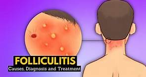 Folliculitis, Causes, Signs and Symptoms, Diagnosis and Treatment.