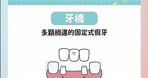 假牙要選哪一種呢？ #健康盟 #缺牙治療 #固定假牙種類 #單顆假牙 #假牙優缺點