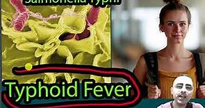 Typhoid Fever: Symptoms, Causes and treatment