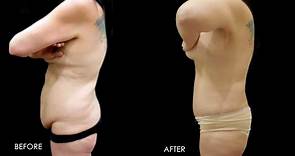 Before & After Tummy Tuck. Fupa Procedure #5019 · Gemini Plastic Surgery & Medical Spa · Upland