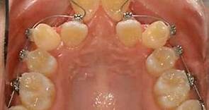 不拔牙的齒列矯正→DAMON + L.H.的牙齒矯正