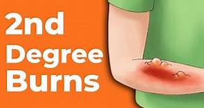 2nd Degree Burns: How to Treat Them | Wound Care OC