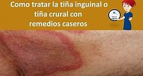 Como tratar la tiña inguinal o tiña crural con remedios caseros