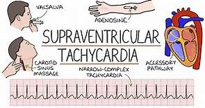 Understanding Supraventricular Tachycardia (SVT)