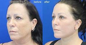 The Facelift Just One Week Later By Dr. Dass Beverly Hills