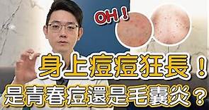 東抓抓西癢癢，遠離毛囊炎這些細節你有做到嗎？蕭全佑醫師告訴大家如何避免毛囊炎！