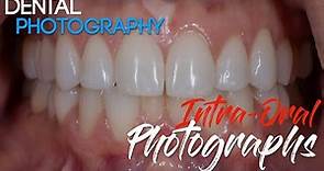 Dental Photography Basics - Dental Photography Techniques - Intra-oral Photographs