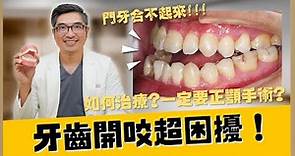 開咬是什麼？比"深咬"更困擾的咬合問題！連麵條都沒辦法咬斷😰｜【祐民牙醫－隱適美旗艦店】鑽石級楊大為醫師 #咬合 #牙齒矯正 #開咬