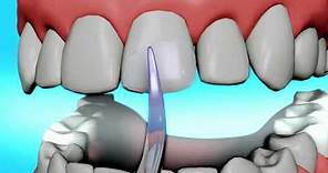 Dental Bonding Video | Tooth Bonding