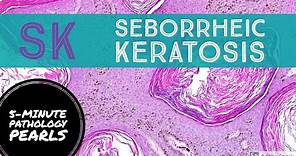 Seborrheic Keratosis: 5-Minute Pathology Pearls