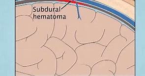 Understanding Subdural Hematoma