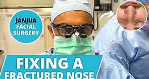 HOW TO FIX A FRACTURED NOSE - DR. TANVEER JANJUA - NEW JERSEY