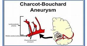 Charcot Bouchard Aneurysm