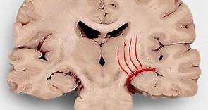 Basal ganglia hemorrhage | Radiology Reference Article | Radiopaedia.org
