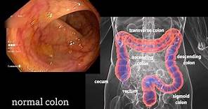 Colonoscopy: A Journey Though the Colon and Removal of Polyps