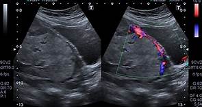 Placenta accreta | Radiology Case | Radiopaedia.org