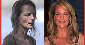 Helen Hunt Plastic Surgery Before and After Photos