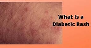 What Is a Diabetic Rash