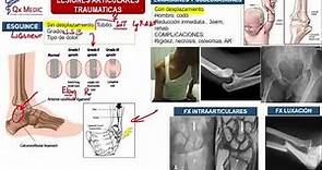 Fracturas: Lesiones de Partes Blandas - Ortopedia y Traumatología (Clases Qx Medic) - 04