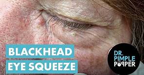 Blackhead Eye Squeeze