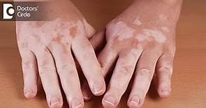 What are the causes of vitiligo? - Dr. Aruna Prasad