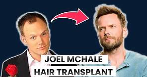 Joel McHale Hair Transplant | Celebrity Hair Transplant
