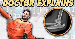 Doctor's Guide to Hugo Lloris Elbow Dislocation